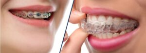 Orthodontic Treatment Cost Braces vs Invisalign