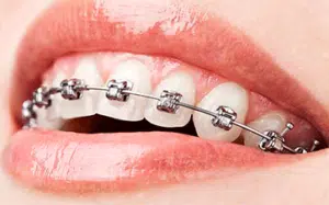 Metal Braces
