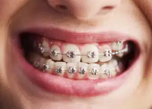 Affordable Braces Options in Farmington