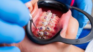 Early Orthodontic Treatment in Flagstaff When Should You Start