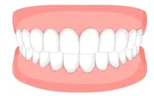 Crowded teeth