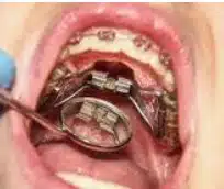 what is expanders