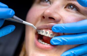 orthodontic treatment