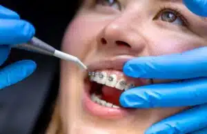 orthodontic treatment