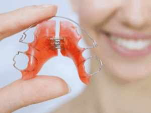 How long does an expander stay in the mouth