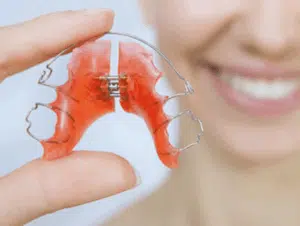 How long does an expander stay in the mouth