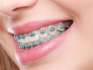 how much does it cost for braces without insurance