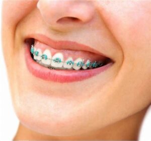 How much do braces cost without insurance?