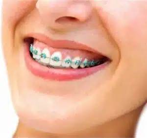 How much do braces cost without insurance?