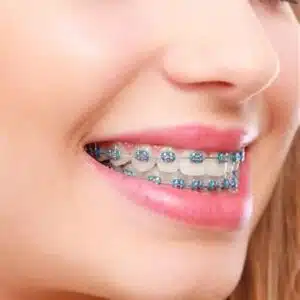 What is the cost of braces without insurance?