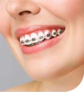 Cost of braces without insurance