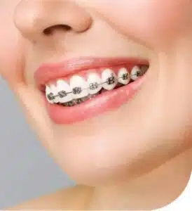 Cost of braces without insurance