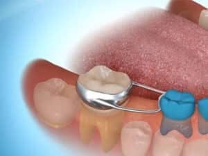 how long do spacers stay in