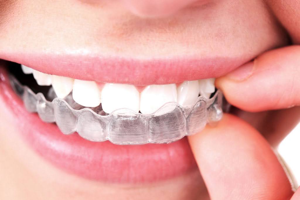 How Invisalign Looks on Teeth for a woman wearing Invisalign