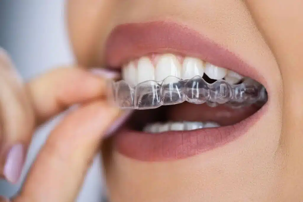 What does Invisalign look like on a woman wearing Invisalign