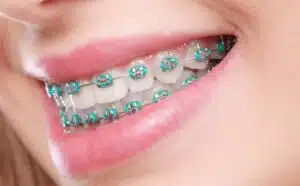 Smiling woman with braces, how long does braces soreness last