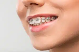 Smiling woman with braces, when do braces stop hurting