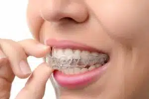 Woman wearing Invisalign, does Invisalign work like braces
