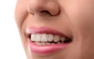 Woman wearing Invisalign, how well do invisalign work