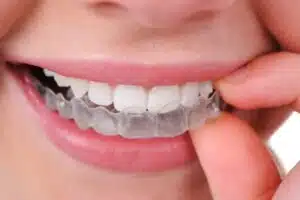 Woman wearing Invisalign, does invisalign aligners work