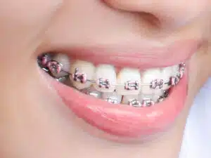 Smiling woman with braces explaining how long do braces hurt