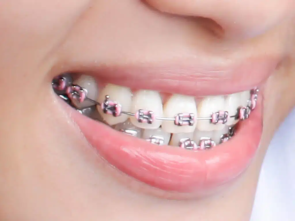 Smiling woman with braces explaining how long do braces hurt