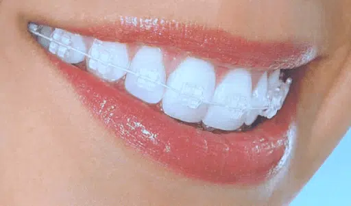 Adult smiling with ceramic clear braces showing discreet orthodontic treatment