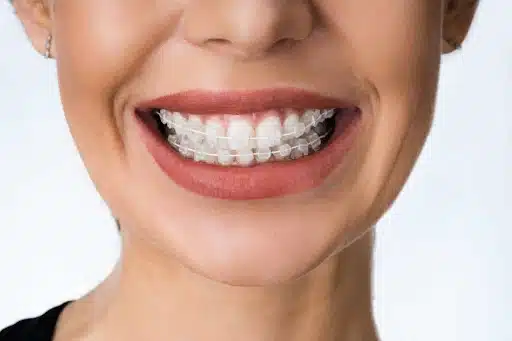 Close-up of ceramic clear braces used for adult orthodontic patients