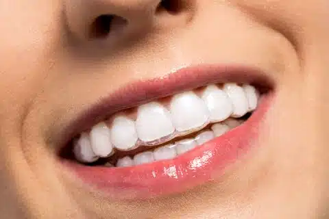 Patient inserting invisalign clear aligners on teeth