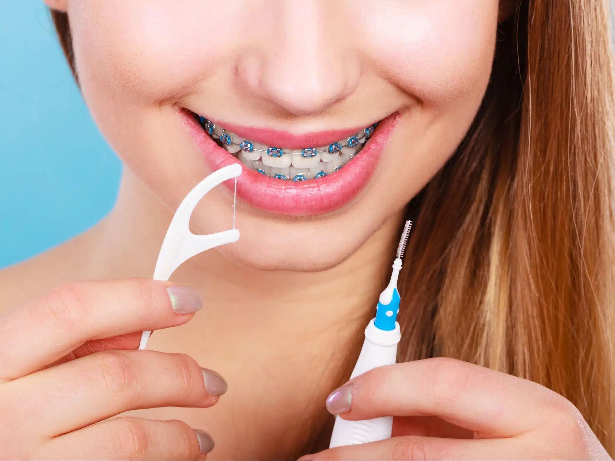 Brushing around braces to protect enamel from white spots