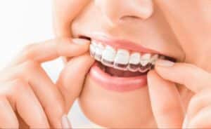 Invisalign trays seating on teeth