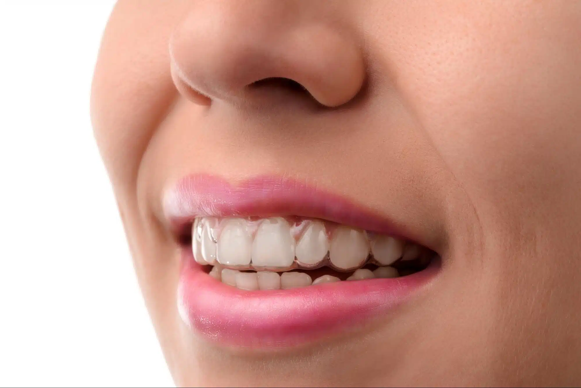Invisalign not tracking and aligners not fitting properly