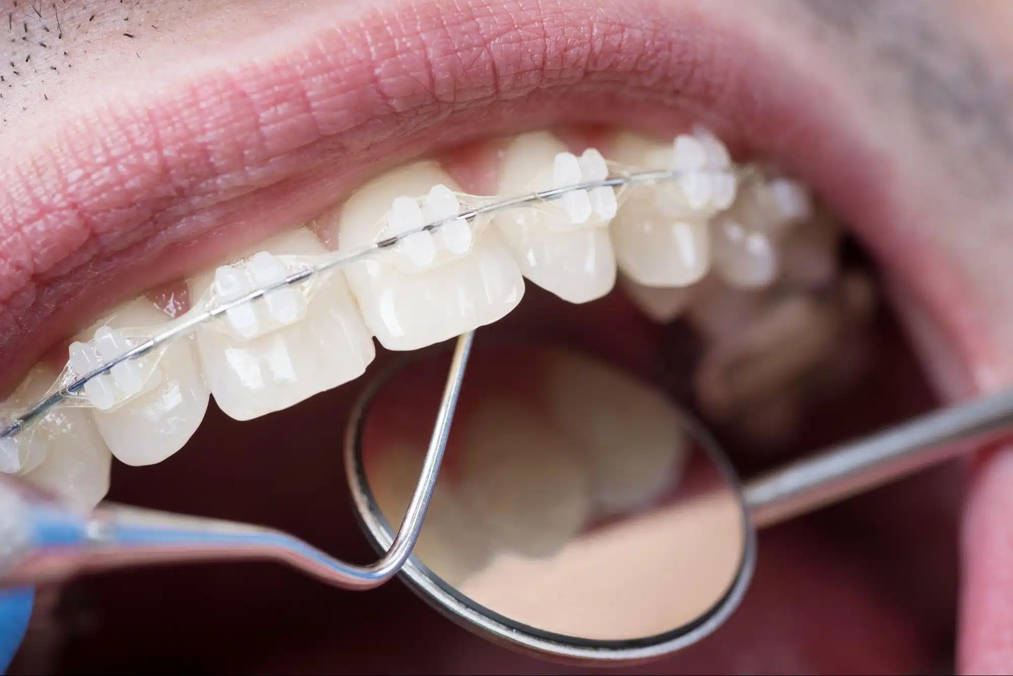 Preventing white spots during braces with good oral hygiene
