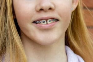 braces closing gaps between teeth