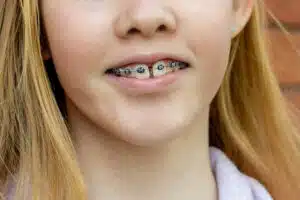 braces closing gaps between teeth